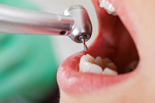 Best Emergency Dentist for Lost Fillings or Crowns in San Anselmo, CA